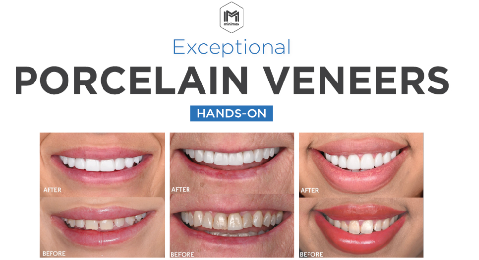 Exceptional PORCELAIN VENEERS Workshop (Brisbane)