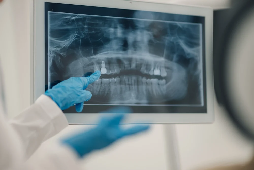 Dental-Implants-And-Dental-Hygiene