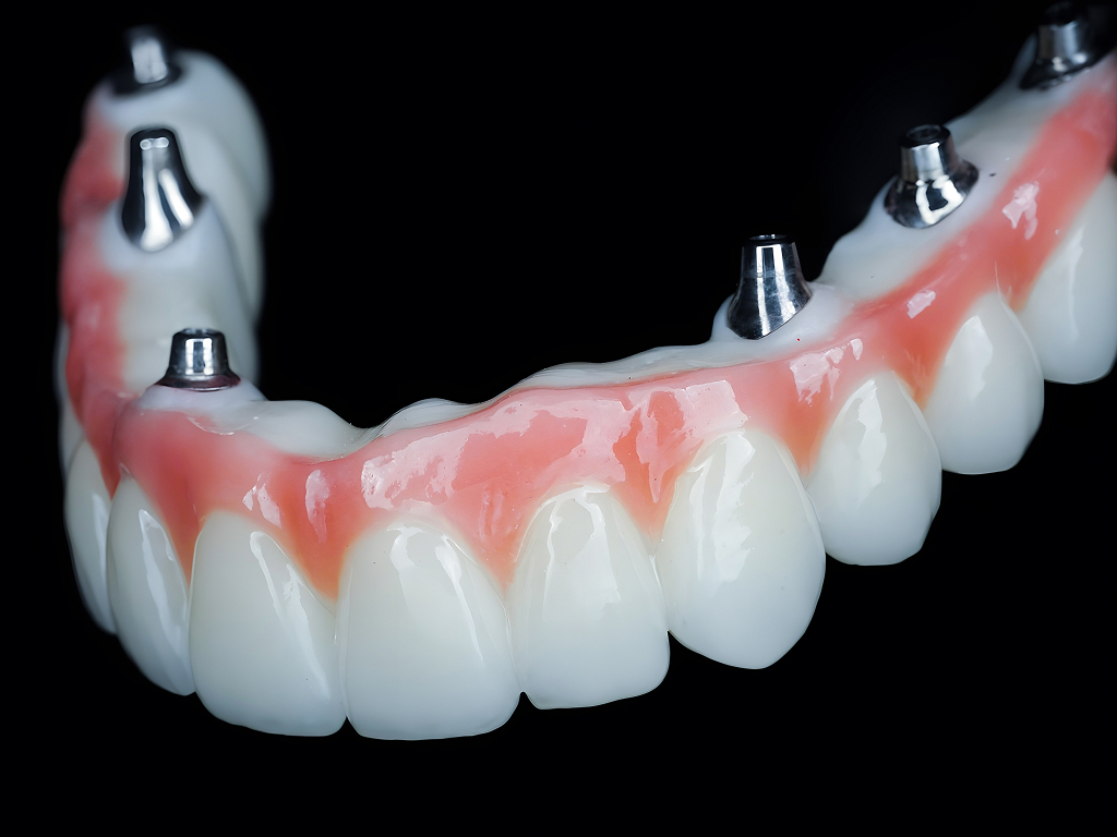 Veneers