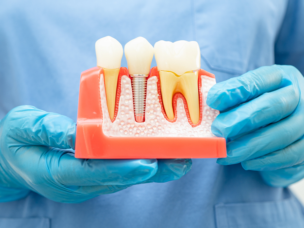 Veneers